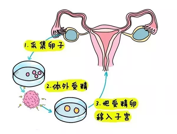流产手术